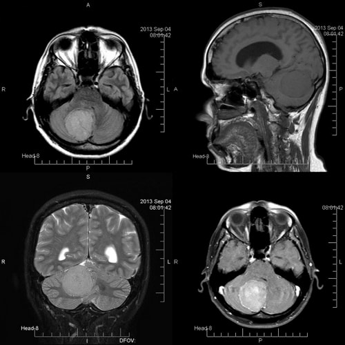 рентген мозга - глиобластома