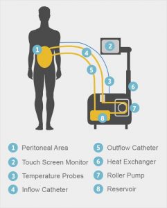 Heated Chemotherapy Treatment: How It Works 