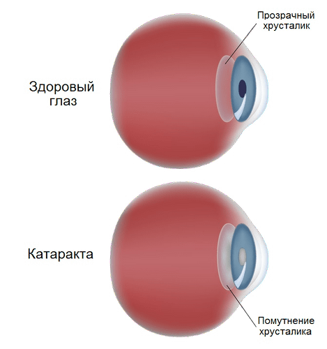 Диагностика и лечение катаракты