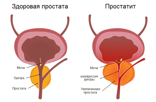 Prostatit katéter
