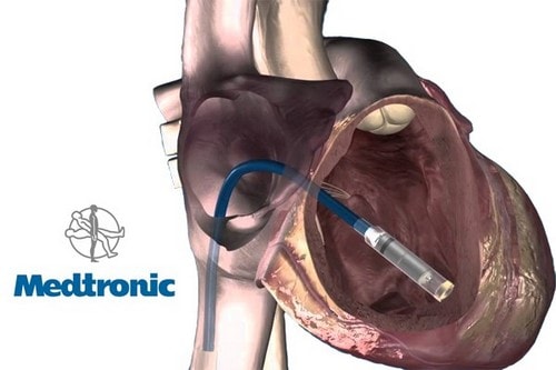 Medtronic's minimally invasive pacemaker