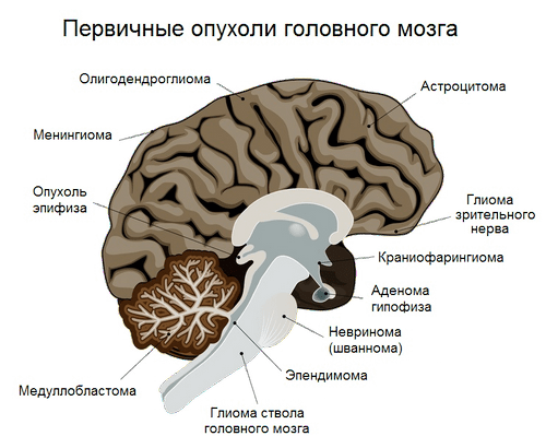 Опухоли головного мозга