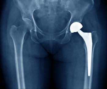 Рентген, с/п замены тазобедренного сустава