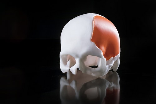 В Израильской больнице установили протез черепа, напечатанный на 3D-принтере