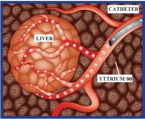 Selective Internal Radiation Therapy (SIRT)